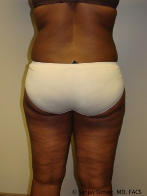Liposuction Before and After 24 | Grover Aesthetics