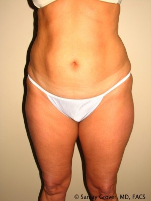 Liposuction Before and After | Grover Aesthetics