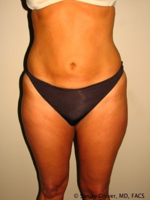 Liposuction Before and After | Grover Aesthetics