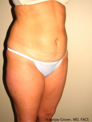 Liposuction Before and After 25 | Grover Aesthetics