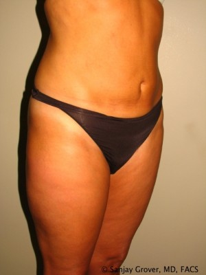 Liposuction Before and After 25 | Grover Aesthetics