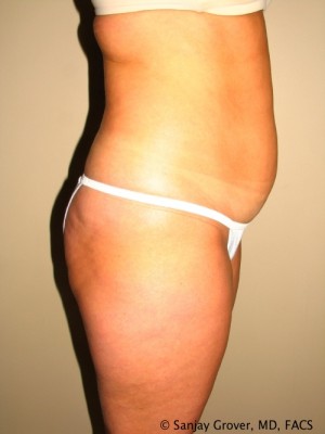 Liposuction Before and After 25 | Grover Aesthetics