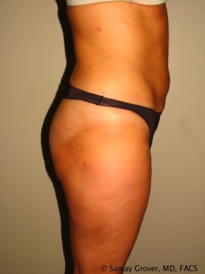 Liposuction Before and After 25 | Grover Aesthetics