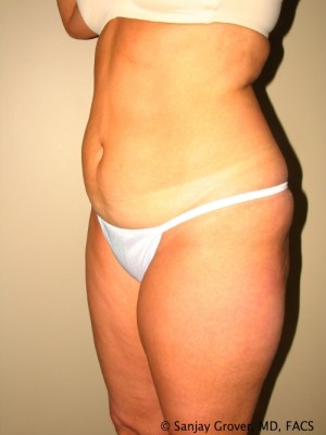Liposuction Before and After 25 | Grover Aesthetics