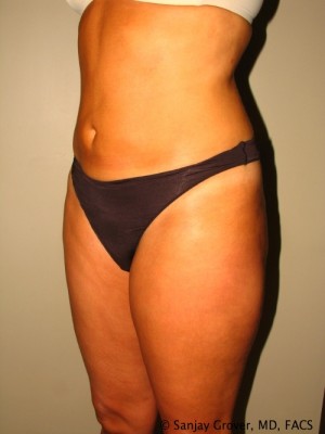 Liposuction Before and After 25 | Grover Aesthetics