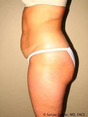 Liposuction Before and After 25 | Grover Aesthetics