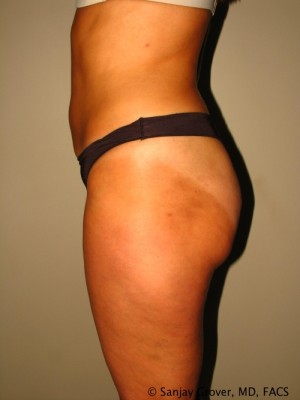 Liposuction Before and After 25 | Grover Aesthetics