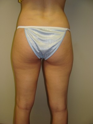 Liposuction Before and After 33 | Sanjay Grover MD FACS