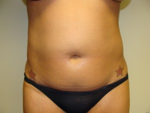 Liposuction Before and After 42 | Sanjay Grover MD FACS