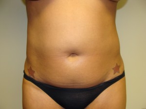 Liposuction Before and After 01 | Sanjay Grover MD FACS