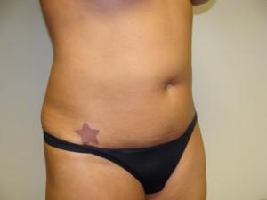 Liposuction Before and After 27 | Grover Aesthetics