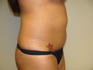 Liposuction Before and After 27 | Grover Aesthetics