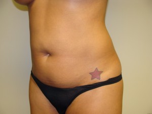 Liposuction Before and After 27 | Grover Aesthetics