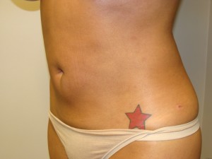 Liposuction Before and After 27 | Grover Aesthetics