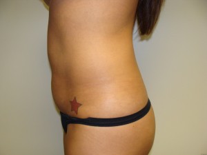 Liposuction Before and After 27 | Grover Aesthetics
