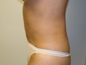 Liposuction Before and After 27 | Grover Aesthetics