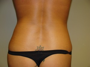 Liposuction Before and After 27 | Grover Aesthetics