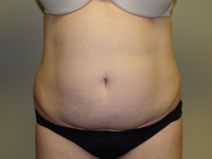 Liposuction Before and After 45 | Sanjay Grover MD FACS