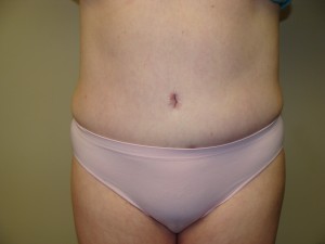 Liposuction Before and After | Grover Aesthetics