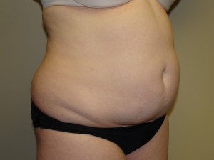 Liposuction Before and After 28 | Grover Aesthetics