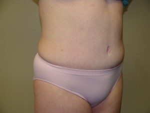 Liposuction Before and After 28 | Grover Aesthetics