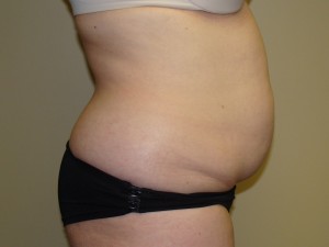 Liposuction Before and After 28 | Grover Aesthetics