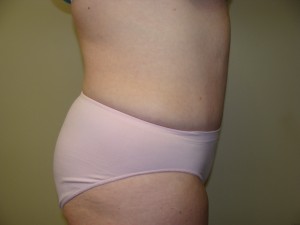 Liposuction Before and After 28 | Grover Aesthetics