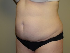 Liposuction Before and After 28 | Grover Aesthetics