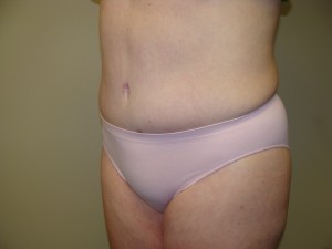 Liposuction Before and After 28 | Grover Aesthetics