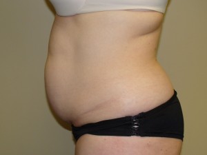 Liposuction Before and After 28 | Grover Aesthetics
