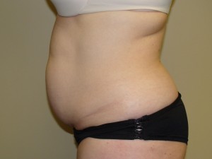 Liposuction Before and After 28 | Sanjay Grover MD FACS