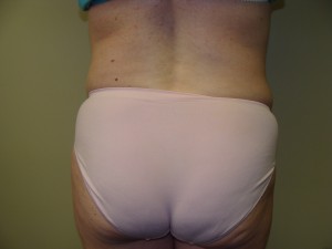 Liposuction Before and After 28 | Sanjay Grover MD FACS