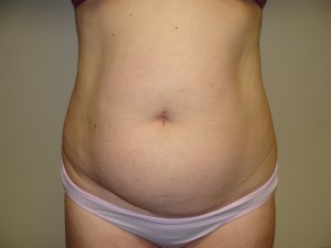 Liposuction Before and After | Grover Aesthetics