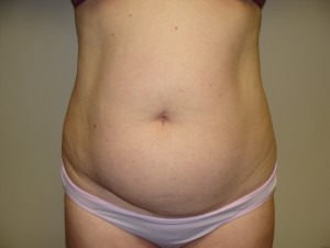 Liposuction Before and After | Sanjay Grover MD FACS