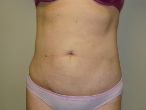 Liposuction Before and After | Grover Aesthetics