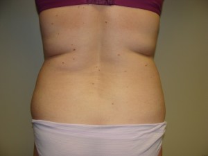 Liposuction Before and After 29 | Sanjay Grover MD FACS