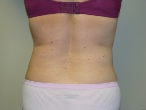 Liposuction Before and After 29 | Grover Aesthetics