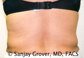 Liposuction Before and After 30 | Sanjay Grover MD FACS