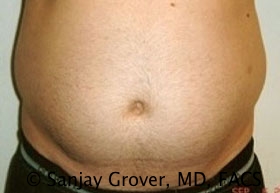 Liposuction Before and After | Grover Aesthetics