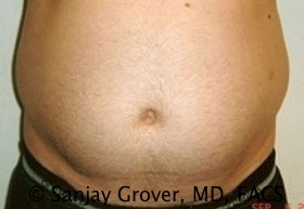 Liposuction Before and After 62 | Sanjay Grover MD FACS