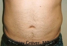 Liposuction Before and After 31 | Sanjay Grover MD FACS