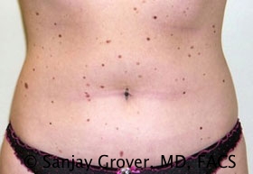 Liposuction Before and After 01 | Sanjay Grover MD FACS