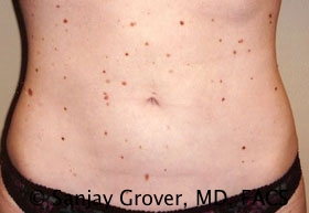 Liposuction Before and After | Grover Aesthetics