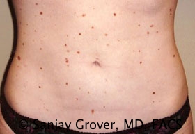 Liposuction Before and After 32 | Sanjay Grover MD FACS