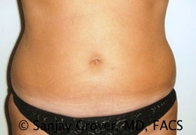 Liposuction Before and After 59 | Sanjay Grover MD FACS