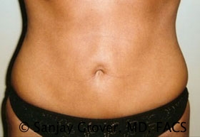 Liposuction Before and After 33 | Sanjay Grover MD FACS