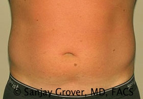 Liposuction Before and After 62 | Sanjay Grover MD FACS