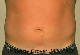 Liposuction Before and After 63 | Sanjay Grover MD FACS