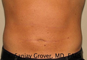 Liposuction Before and After 34 | Sanjay Grover MD FACS