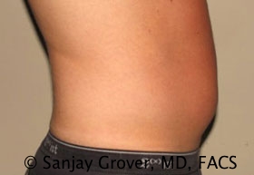 Liposuction Before and After 34 | Sanjay Grover MD FACS